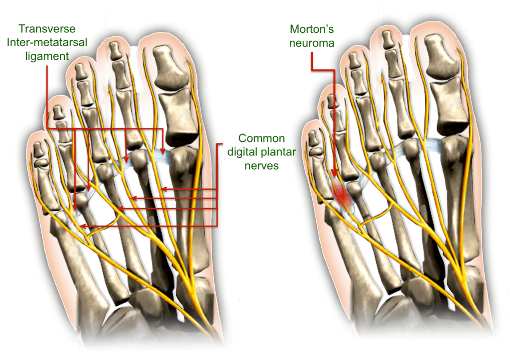 Morton's neuroma anatomy