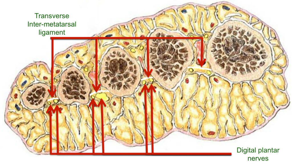 mortons-neuroma foot-cross-section