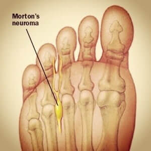 mortons neuroma