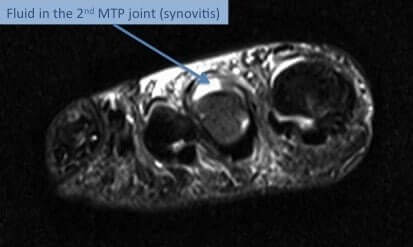 MTP synovitis