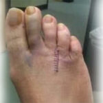 Morton's neuroma surgery