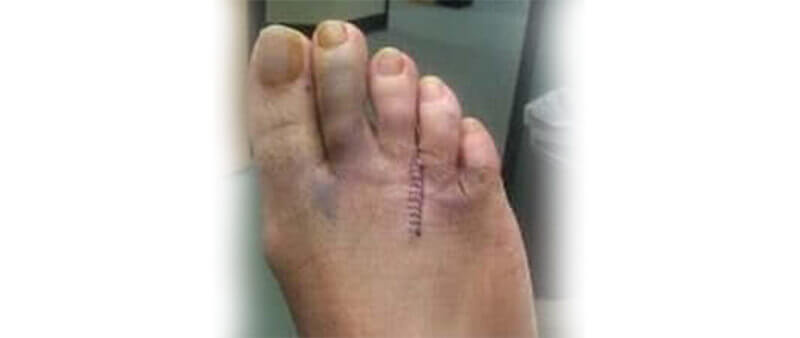 Morton's neuroma surgery