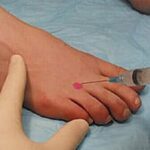 corticosteroid injection for Morton's neuroma