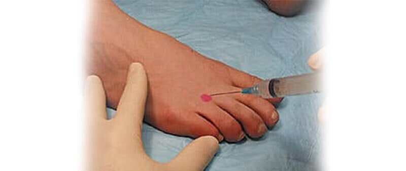 corticosteroid injection for Morton's neuroma