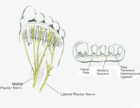 mortons neuroma location