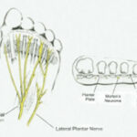 morton's neuroma ligament
