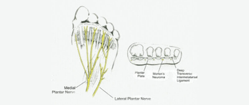 morton's neuroma ligament