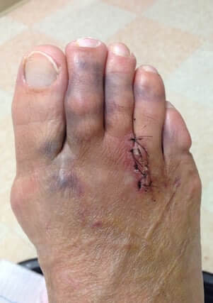 failed neuroma surgery