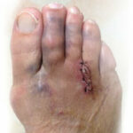 failed Morton's neuroma surgery