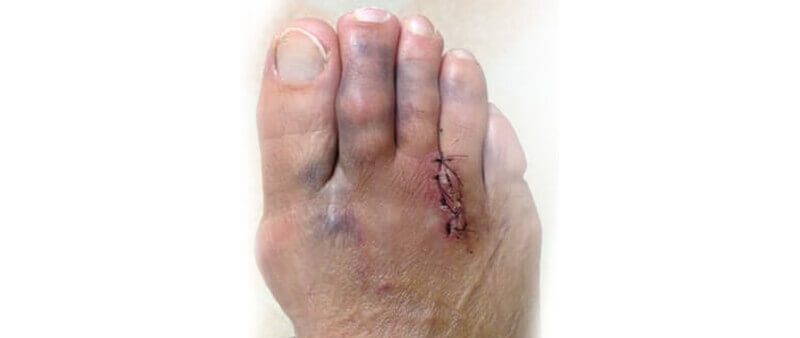 failed Morton's neuroma surgery