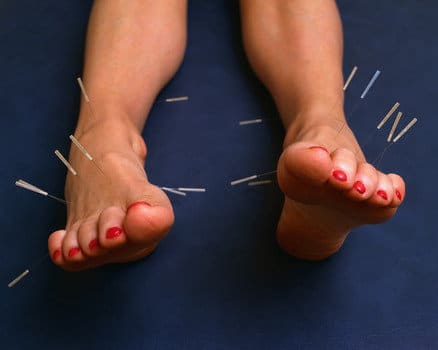 Foot acupuncture for morton's neruoma