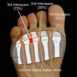 Morton's neuroma location