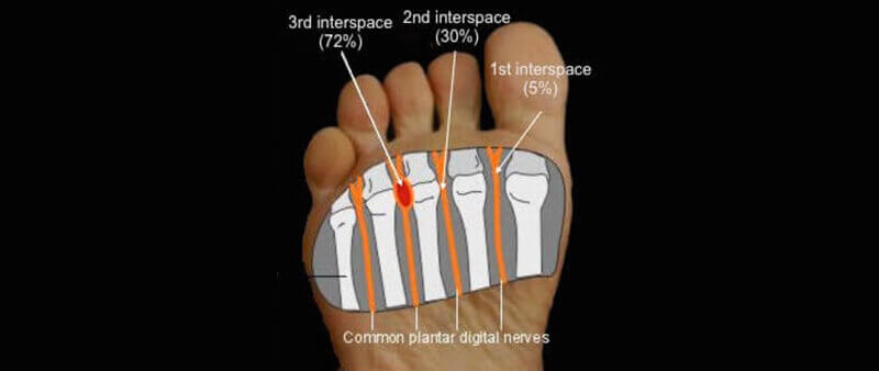 Morton's neuroma location