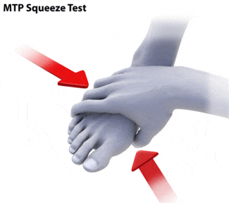 Metatarsalgia squeeze test