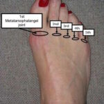 Mortons neuroma Metatarsophalangeal joints