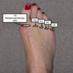 MTP joint pain