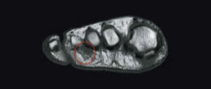 Morton's neuroma MRI