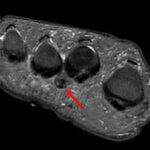 foot neuroma MRI