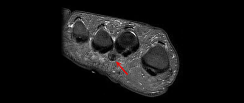 foot neuroma MRI