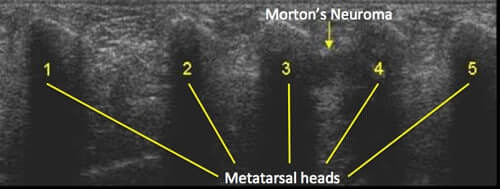 mortons neuroma ultrasound