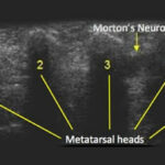 Morton's neuroma ultrasound