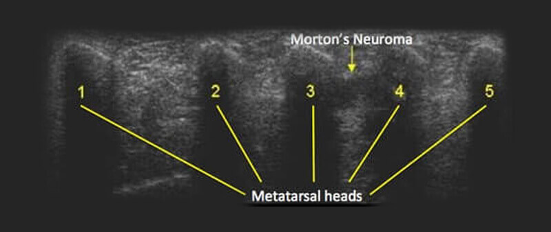 Morton's neuroma ultrasound