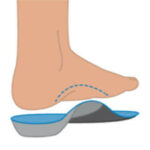 Morton's neuroma custom orthotics