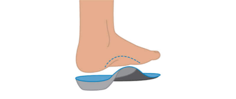 Morton's neuroma custom orthotics