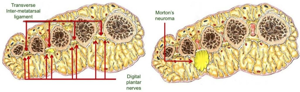 Causes of Morton's neuroma