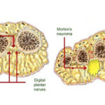 Morton's neuroma anatomy