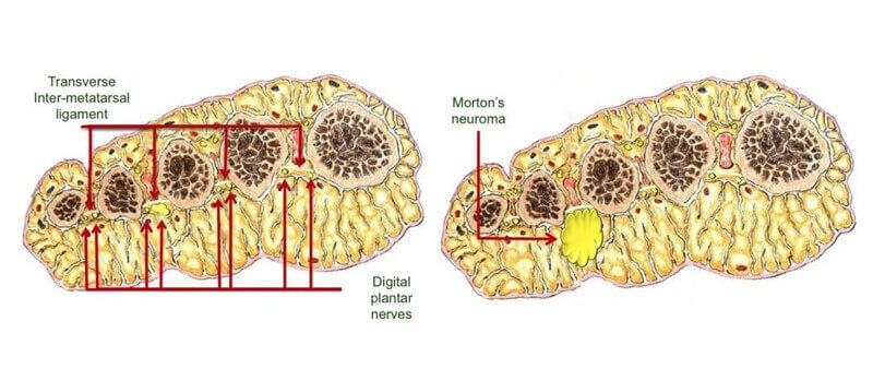 Morton's neuroma anatomy