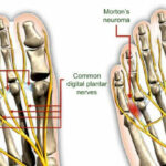 morton's neruoma anatomy