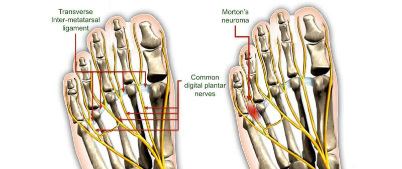 morton's neruoma anatomy