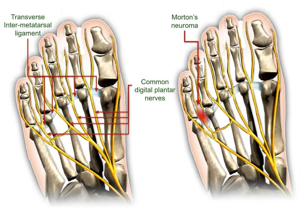 Causes of Morton's neuroma