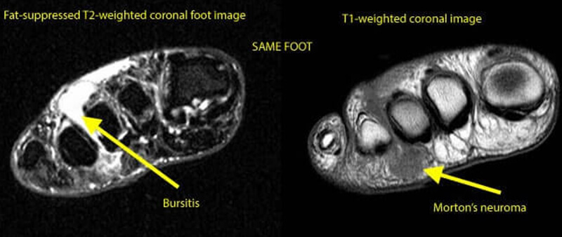 bursitis and morton's neruoma