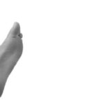 Mortons neuroma progression