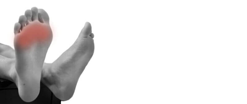 Mortons neuroma progression
