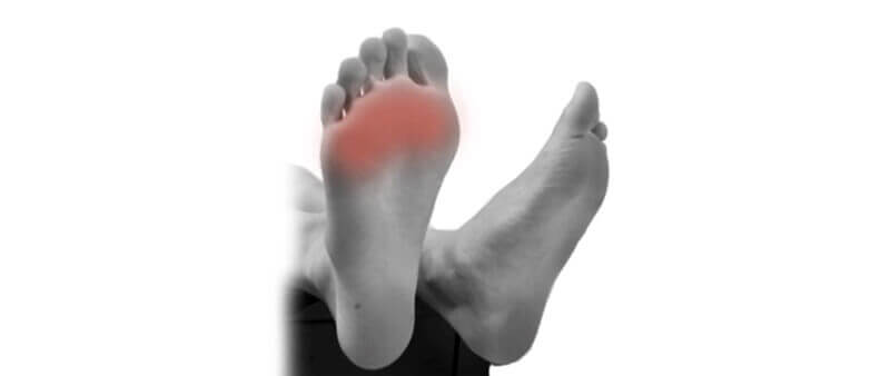 Morton's neuroma pain