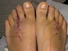 Morton's surgery