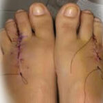 Morton's neuroma treatment