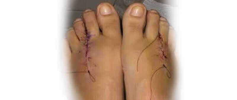 Morton's neuroma treatment