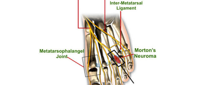 morton's surgery