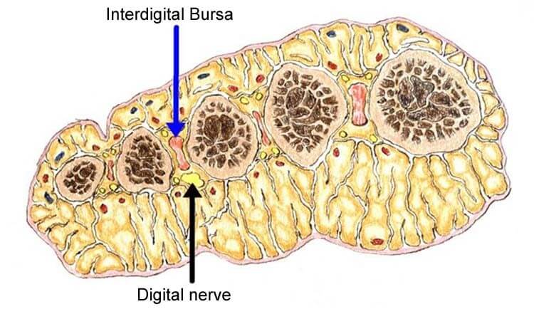 Morton's neuroma anatomy