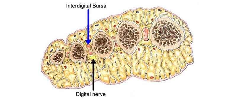 mortons neuroma and bursitis