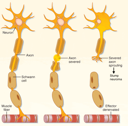 Wallerian degeneration