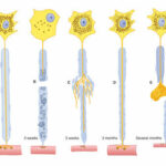 motrons nerve degeneration