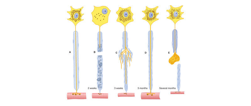 motrons nerve degeneration