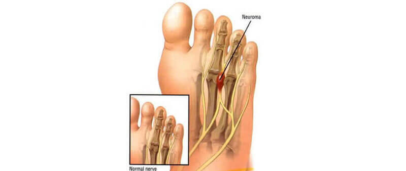 Morton's neuroma