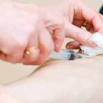 PRP for neuroma