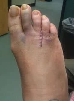 Morton's neuroma surgery